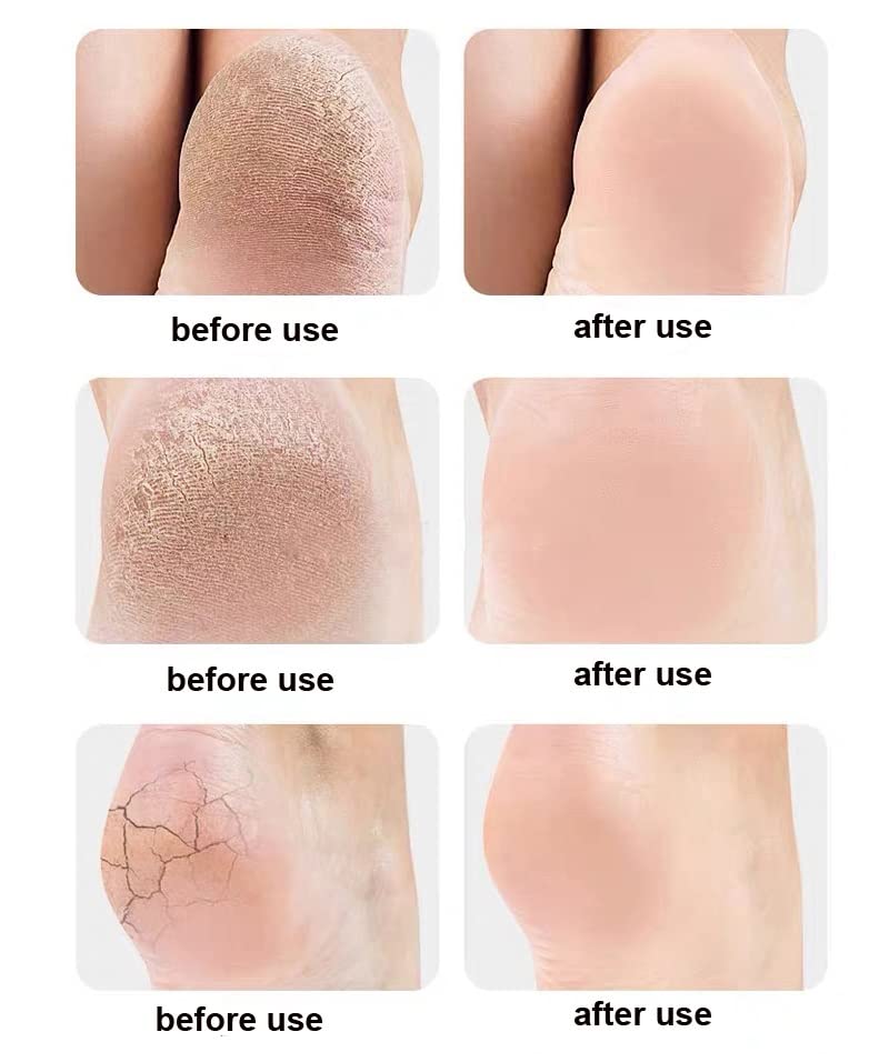 Anti crack heel